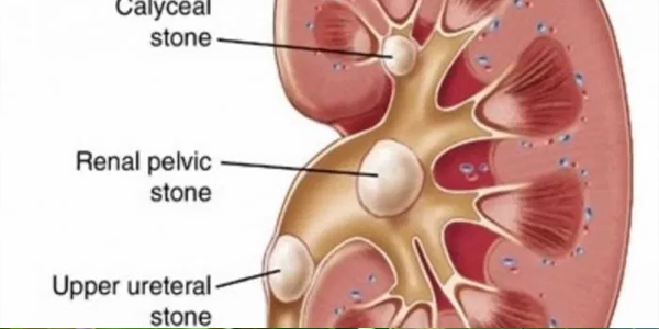 पथरी के लक्षण और पथरी का इलाज 