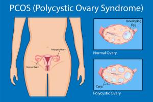 पॉलीसिस्टिक ओवेरियन सिंड्रोम के लिए घरेलू उपचार