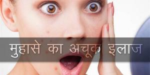 मुहाँसे (पिम्प्प्ल) का अचूक इलाज