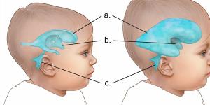 हाइड्रोसेफेलस है गंभीर मानसिक बीमारी, जानें इसके लक्षण और उपचार