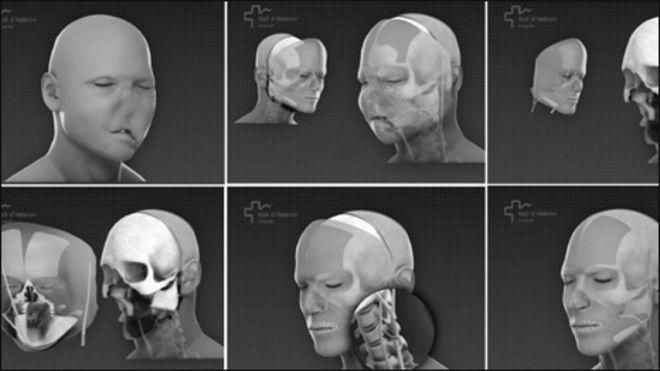 पूरे चेहरे का 'सफल' ट्रांसप्लांट